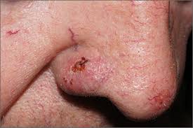 If there is a scratch on your knee put iodine on it. Sore On Nose Mdedge Family Medicine