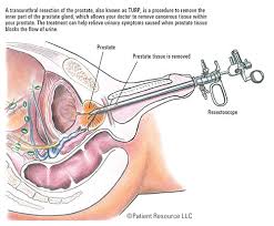 However, few signs can help in detecting prostate cancer. Patient Resource Publishing Advanced Prostate Surgery