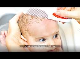 Image result for white scabs on the head in children