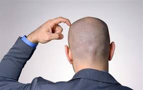 다이어트를 할 경우 단백질 부족으로 인해 성장기에 있던 모발이 휴지기로 전환되어. íƒˆëª¨ í™˜ìž 20 30ëŒ€ê°€ 43 9 ë¡œ ì ˆë°˜ ìœ¡ë°• ì„œìš¸ì‹ ë¬¸