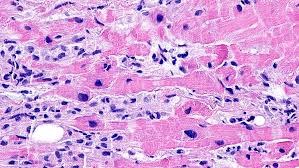 Myocarditis and inflammatory cardiomyopathy are syndromes, not aetiological disease entities. Heart Pathology