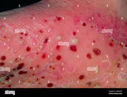 Image result for Pustular Psoriasis