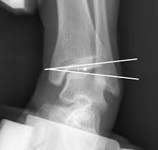 Image result for Talar Tilt