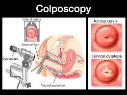 ASCUS PAP Smear & HPV - Anthony Siow