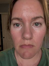 Had sliding Genioplasty done a year ago and as I've healed I've noticed my  chin becoming more ball like in appearance. The surgeon said hyperactive  mentalis muscle and recommended Botox injections which