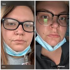 Starface sleep mask review: glowing skin result