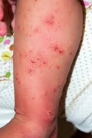 Image result for scabies symptoms