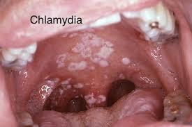 La clamidia (también conocida como clamidiasis) es una infección bacteriana común que se cura fácilmente con antibióticos. Medilab Jalpa Hombre O Mujer Clamidia Sifilis Facebook