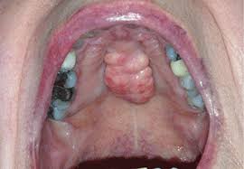 Find the causes of mouth bumps in places such as the roof of mouth, lips, cheeks in some cases a bump in mouth can start out small and white but then become bigger and look like a pimple. Bony Bumps In The Mouth Consult Qd