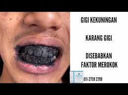 11 cara putihkan gigi yang selamat dan murah, buat apa nak belanja mahal? Cara Memutihkan Gigi Kuning Dengan Cepat Dan Berkesan Youtube