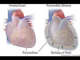 We did not find results for: My Pericarditis Or Heart Fluid Buildup I Think It Was Caused By An Infection It Happened Suddenly Youtube