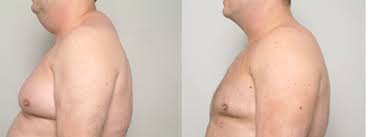 But it is not friendly to the press. Buffalo Hump Correction Breast Augmentation Nipple Correction Surgery San Francisco Ca Dr James Romano