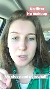 Visible veins in feet and potential connection to Ehlers Danlos Syndromes