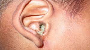 The condition is often seen in patients with a history of acute otitis media with tm rupture and presents with painless otorrhea and conductive hearing loss. Chronic Suppurative Otitis Media Csom Medicforyou