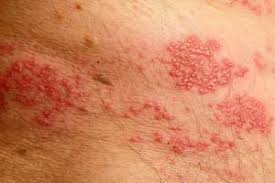 Image result for shingles in children