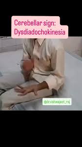 Image result for Rapid Alternating Movements