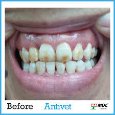 Antivet Case Studies Mdc dental whitening antivet enamel cleaning kit for fluorosis & tobacco. antivet case studies