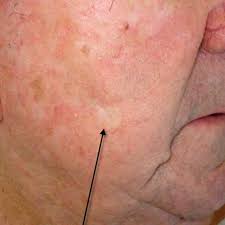 Skin cancer may initially appear as a nodule, rash or irregular patch on the surface of the skin. Skin Cancer Melanoma Signs And Symptoms Skin Cancer Images And Pictures