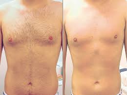 Like electrolysis, this treatment targets the hair follicle. Body Hair Removal Philadelphia Back Hair Removal For Men