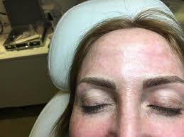 Our microblading experts have traveled back to europe to recieve the highest quality training. Microblading Wow Now I Have Eyebrows Kensington Mums