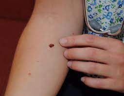 Most tattoo artists promote sun protection for new tattoos in the form of aftercare instructions. Doctors Gain A Greater Understanding Of Skin Eurekalert