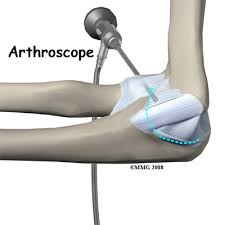 The traditional tommy john procedure, which is more invasive and reconstructs the ucl ligament, is still the current gold standard with decades of research supporting it's effectiveness. Ucl Reconstruction Richmond Va Tommy John Surgery Henrico County Chesterfield County