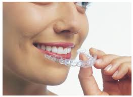 Invisalign vs Braces
