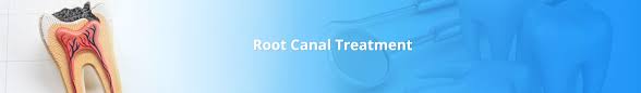 A root canal (endodontic) procedure can seem daunting and you may be unsure of the costs involved. Root Canal Treatment In Bangalore Root Canal Procedure Cost In India