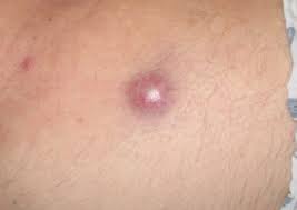 Image result for Merkel Cell Carcinoma