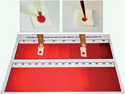 Patients Blood Samples Being Prepared And Compared To The