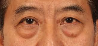 Wong Chin Ho W Aesthetics Plastic Surgery Lower Eyelids