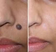 How To Get Rid Of Moles Naturally Best Way To Get Rid Of Moles Warts And Skin Tags Home Remedies For Skin Skin Tag Removal Skin Moles