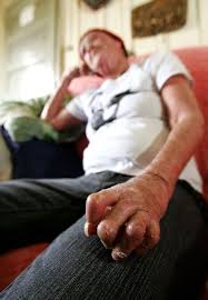 The prevalence is as high as 3.4%. A Luta Contra As Feridas Da Pele E Da Alma