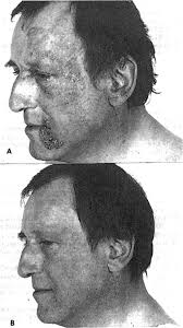 Successful treatment of primary progressive follicular mucinosis with  interferons