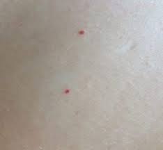 Cele cinci kilograme date jos nu sunt grasime, ci mai degraba lichidele acumulate in. Timp Liber Pete Hepatice Alunite Rosii Pete Facebook