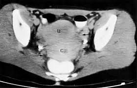 How is endometriosis formally diagnosed? Ct Atlas Glowm
