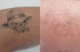 We pride ourselves on exceeding the expectations of every client. Tattoo Removal Sunshine Coast