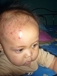 Tapi sebenarnya apasih penyebab bisul dan bagaimana cara mengobati bisul ? Bisul Oh Bisul Cara Mengubati Bisul Ceritera Si Gadis Biru