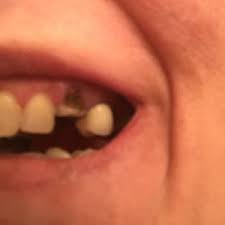 How to remove a broken tooth. Previous Root Canal Tooth Broke In Half And Now In The Front I M So Scared They Won T Be Able To Crown It Photo