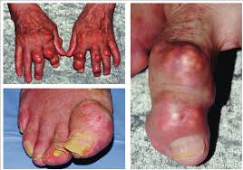 Image result for gout symptoms toe