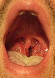 Can oral sex cause streptococcus
