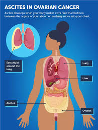 Image result for Ascites