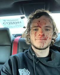 A gunshot wound (gsw) is physical trauma caused by a projectile from a firearm. Youtuber Whistlindiesel Survives After Accidentally Shooting Himself In Forehead With Stray Bullet From His Gun