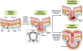 Etiopathogenetic Mechanisms In Diverticular Disease Of The Colon Cellular And Molecular Gastroenterology And Hepatology