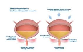 Image result for Stress Incontinence