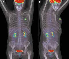 Ct scans can be used to identify disease or injury within various regions of the body. Pet Ct Scan Of A Patient With Breast Cancer A Trace Amount Of Download Scientific Diagram
