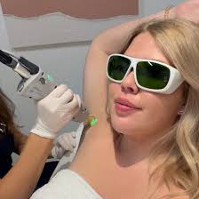 Top 5 Benefits of Laser Hair Removal