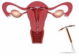 اللولب الرحمي (intrauterine device) هو أداة صغيرة على شكل حرف t يتم إدخالها إلى الرحم وتعمل على إطلاق كميات صغيرة من هرمون البروجسترون على فترات لمنع الحمل، فكيف تتم عملية تركيب اللولب؟. Ø§Ù„Ù„ÙˆÙ„Ø¨ Ø§Ù„Ù†Ø­Ø§Ø³ÙŠ Copper T Ø§Ù„Ù„ÙˆÙ„Ø¨ Ø§Ù„Ø±Ø­Ù…ÙŠ Iud Ù‡Ùˆ Ø¹Ø¨Ø§Ø±Ø© Ø¹Ù† Ø·Ø±ÙŠÙ‚Ø© Ù„Ù…Ù†Ø¹ Ø§Ù„Ø­Ù…Ù„ ÙŠØ³ØªØ®Ø¯Ù… ÙÙŠÙ‡Ø§ Ø¹Ø§Ø²Ù„ ÙŠØªÙ… Ø²Ø±Ø¹Ù‡ ÙÙŠ Ø¯Ø§Ø®Ù„ Ø¬Ø³Ù… Ø§Ù„Ø±Ø­Ù… Ùˆ ÙŠÙƒÙˆÙ† Ø¬Ù‡Ø§Ø² Ø¨Ù„Ø§Ø³ØªÙŠÙƒÙŠ Ù…ØºØ·Ù‰ Ø§Ø­ÙŠØ§Ù†Ø§ Ø¨Ø§Ù„Ù†Ø­Ø§Ø³ Ø§Ùˆ Ø¨Ø§Ù„Ø¨Ø±ÙˆØ¬Ø³ØªØ±ÙŠÙ† ÙŠÙˆØ¶Ø¹