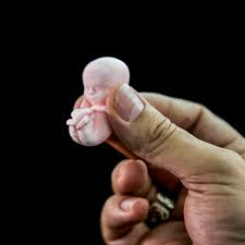 This is because the process of ovulation begins after an abortion, though you might be having slight bleeding or spotting. States Prohibit Abortion Based On Race Sex And Genetic Abnormality The Atlantic