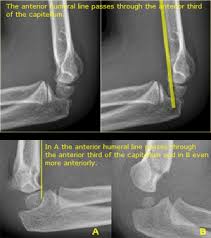 The cases of 214 children (mean the elbow was then extended to no more than 60° of flexion. Supracondylar Humeral Fracture Physiopedia
